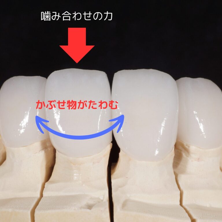 CAD-CAM冠は本当に大丈夫なのか?② たわむ?? | 医療法人社団デンタルキュア ワイズデンタルキュア