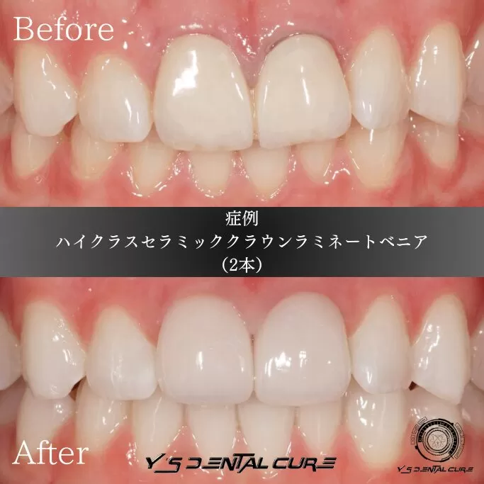 古い被せもののお直し