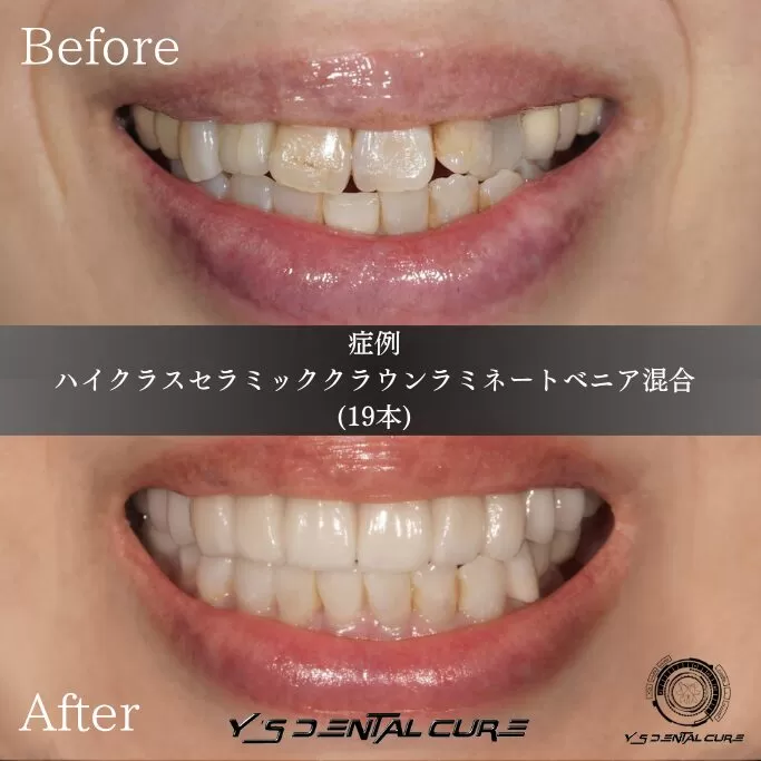 あなたの顎、曲がっていませんか?リハビリで歯を本来の位置へ