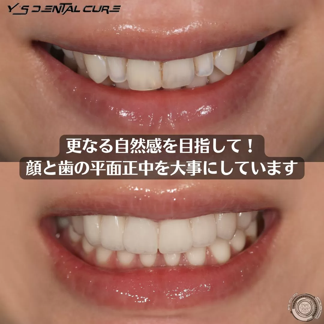 ②更なる自然感を目指して! 歯の平面感を大事にしています