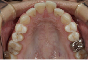 裏側矯正、舌側矯正のハーモニー一年半経過の症例。