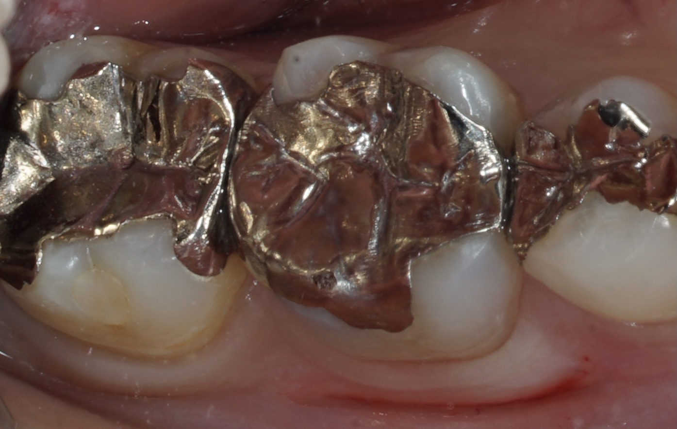 虫歯の都市伝説　銀歯のリスク　ワイズデンタルキュアのブログ