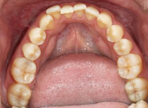 下の歯、裏側矯正、舌側矯正の歯並び前後、下顎編。ワイズデンタルキュアのブログ