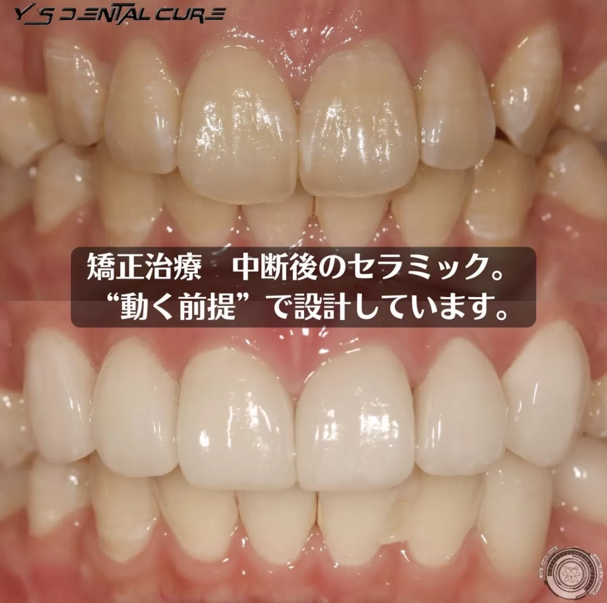 矯正治療中断後のセラミック。”動く前提”で設計しています。