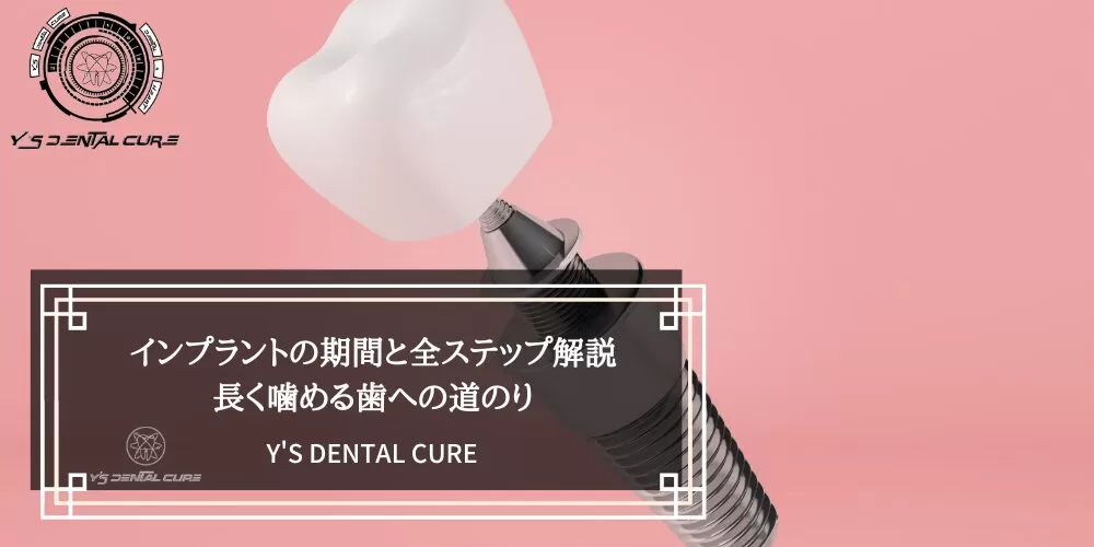 インプラントの期間と全ステップ解説｜長く噛める歯への道のり