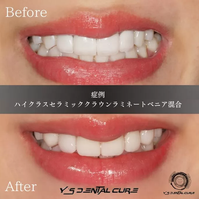 笑顔をつくるのに「唇に力が入る歯」と「唇が楽な歯」の違い