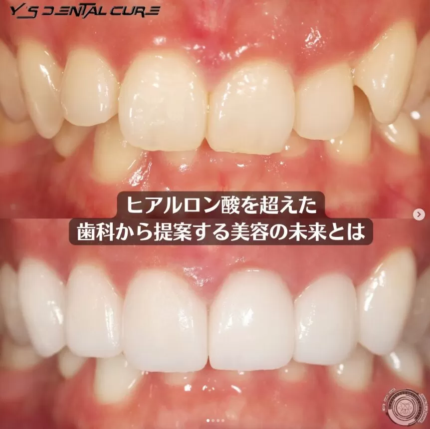 ヒアルロン酸を超えた、歯科治療の未来とは