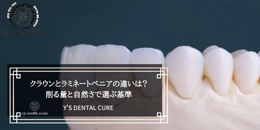 クラウンとラミネートベニアの違いは？削る量と自然さで選ぶ基準