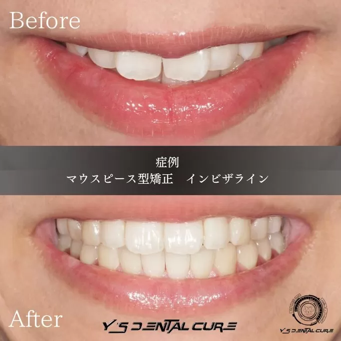 歯並びを顎関節基準で整える マウスピース型矯正