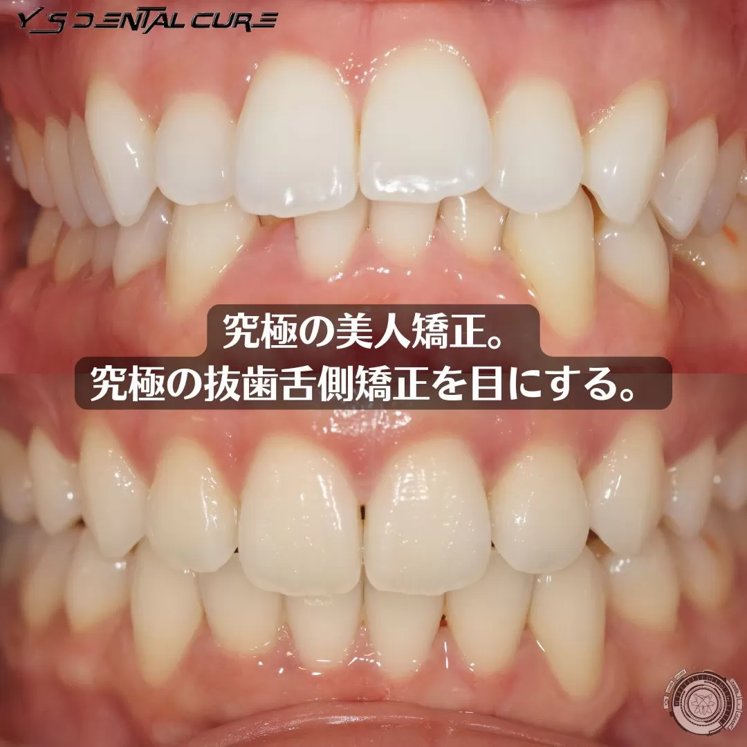 究極の美人矯正。究極の抜歯舌側矯正を目にする。