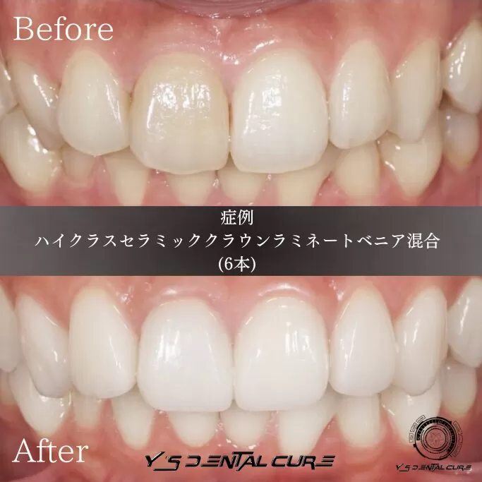神経を残すことを提案したセラミック治療