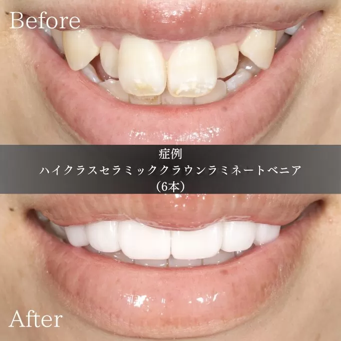 身体の玄関、門歯について