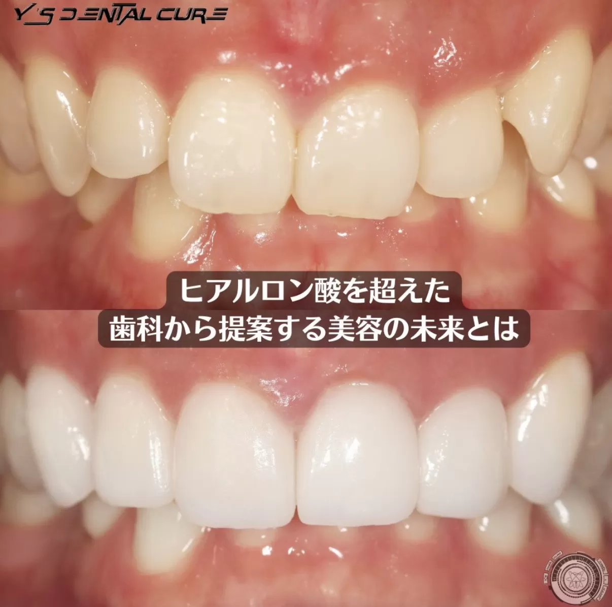 ヒアルロン酸を超えた歯科から提案する美容の未来とは