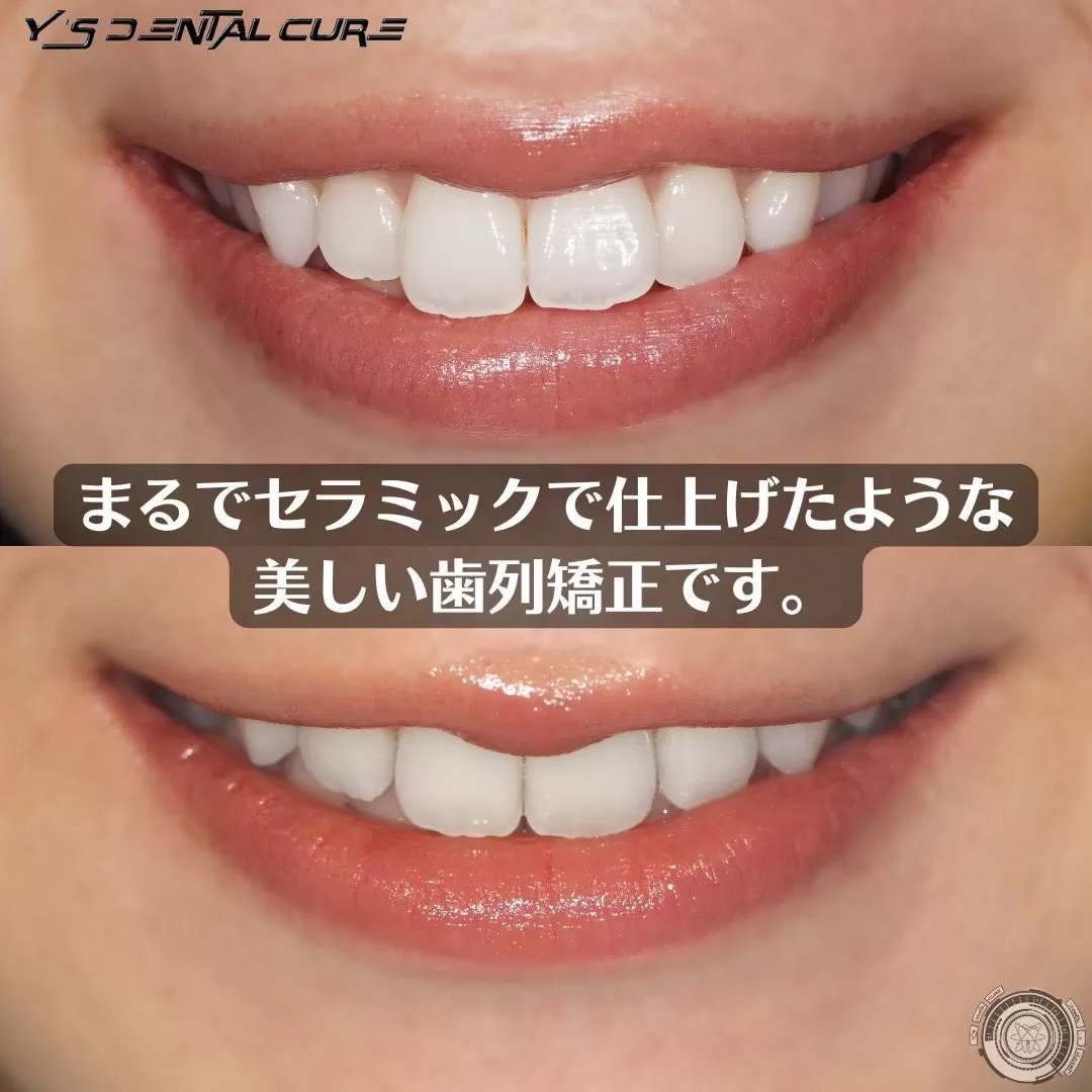 まるでセラミックで仕上げたような美しい歯列矯正です。