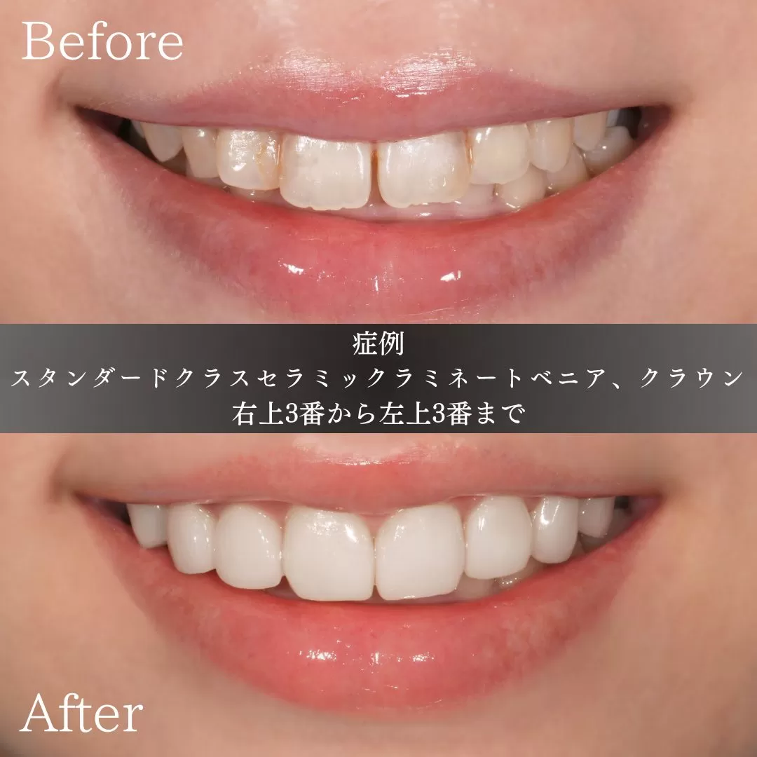 整える、ということを主眼においた2Dセラミックの症例。