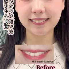 コンプレックスだったうさぎちゃん前歯