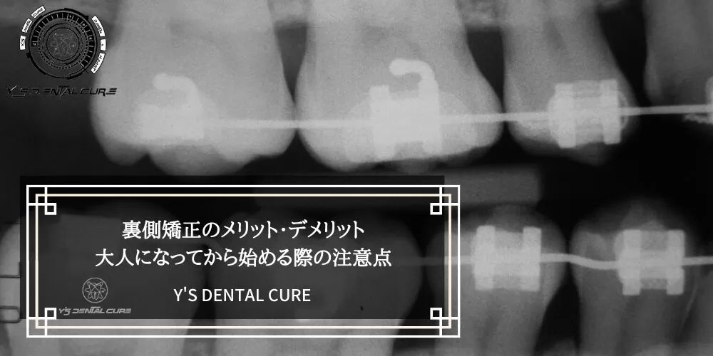裏側矯正のメリット・デメリット｜大人になってから始める際の注意点