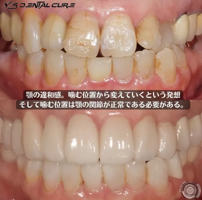 長年悩んでいた顎の歪み