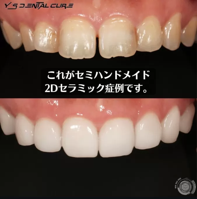 セミハンドメイド2Dセラミック