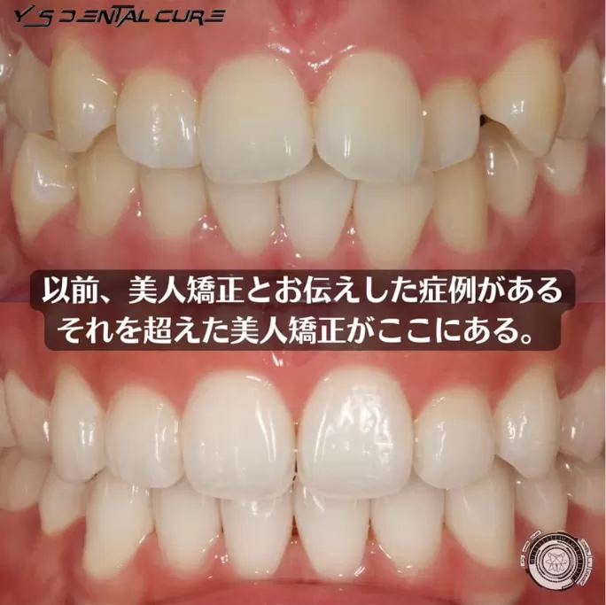 2Dセラミックで歯並びを整える